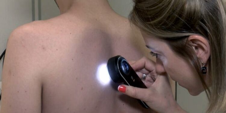 Vuelven los chequeos gratuitos para generar concientizar sobre el cáncer de piel