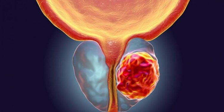 Cada 45 minutos una persona es diagnosticada con cáncer de próstata en Argentina