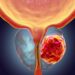 Cada 45 minutos una persona es diagnosticada con cáncer de próstata en Argentina