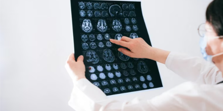 Cada día se detectan en Argentina 5 casos de tumores cerebrales: ¿cuáles son los signos de alerta?