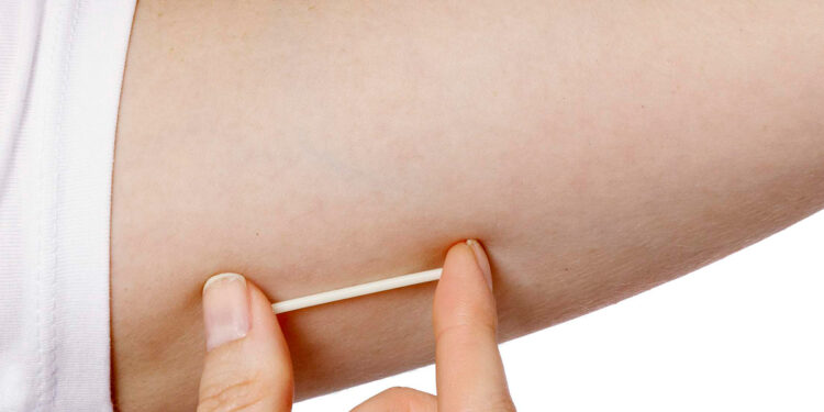 Habrá una jornada de colocación gratuita de implantes subdérmicos