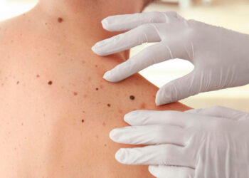 Crecen los casos de cáncer de piel en todas las edades