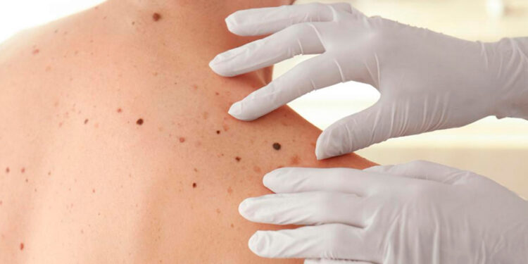 Crecen los casos de cáncer de piel en todas las edades