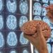 Avanza vacuna personalizada contra el tumor cerebral más letal: resultados prometedores