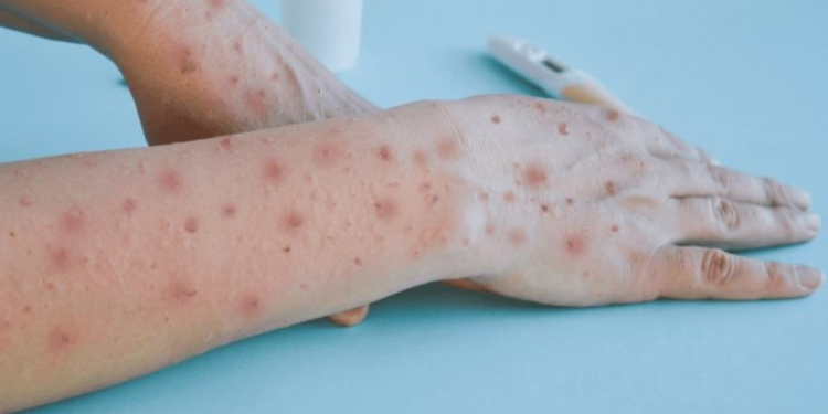 La OMS declara una emergencia sanitaria internacional por brote de mpox