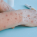 La OMS declara una emergencia sanitaria internacional por brote de mpox