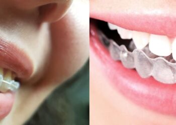 Por qué elegir brackets invisibles para tu tratamiento dental