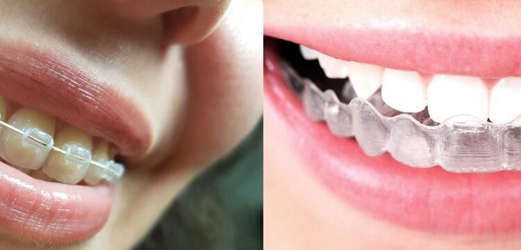 Por qué elegir brackets invisibles para tu tratamiento dental