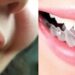 Por qué elegir brackets invisibles para tu tratamiento dental