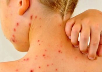 Alarma en CABA por un brote feroz de sarampión: empezó en Palermo y ya golpea a otros barrios
