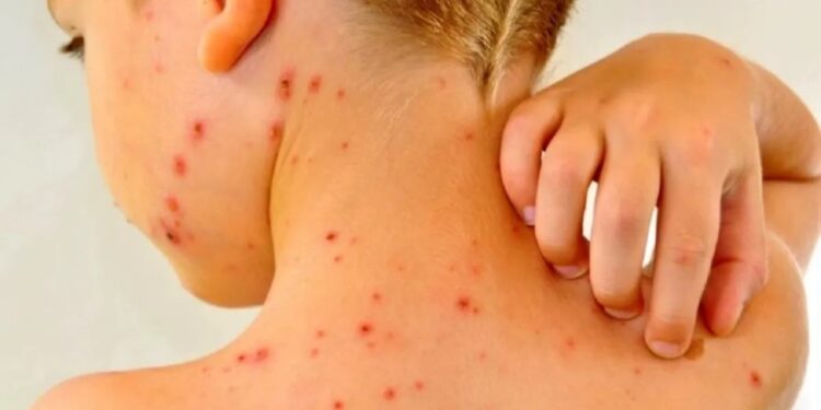 Alarma en CABA por un brote feroz de sarampión: empezó en Palermo y ya golpea a otros barrios