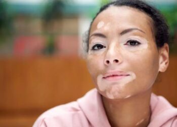 Día Mundial del Vitiligo: ¿por qué se conmemora el 25 de junio?
