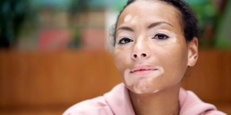 Día Mundial del Vitiligo: ¿por qué se conmemora el 25 de junio?