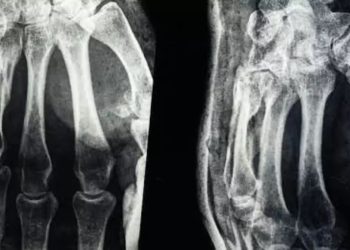 Desarrollan un gel que ensaya una técnica para soldar huesos en apenas tres minutos