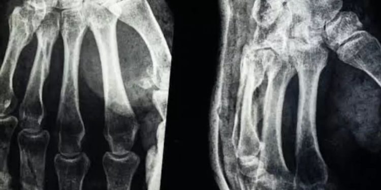 Desarrollan un gel que ensaya una técnica para soldar huesos en apenas tres minutos