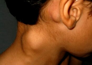 Linfoma, una enfermedad que padece 1 de cada 5.000 argentinos