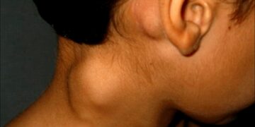 Linfoma, una enfermedad que padece 1 de cada 5.000 argentinos