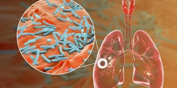 Alerta tuberculosis: se notificaron más de 13.000 casos en Argentina