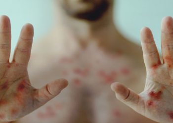 Alerta sanitaria en Argentina: los casos de sífilis aumentaron un 71% y marcan un récord histórico