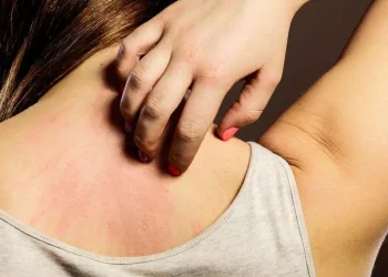 Día Mundial de la Alergia: ¿por qué se conmemora el 8 de julio?