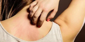 Día Mundial de la Alergia: ¿por qué se conmemora el 8 de julio?