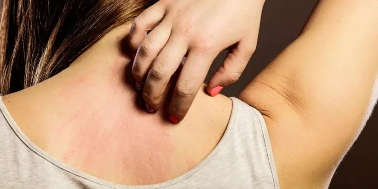 Día Mundial de la Alergia: ¿por qué se conmemora el 8 de julio?