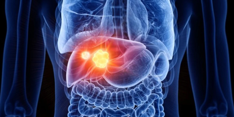 Identifican una nueva vía para potenciar la inmunoterapia contra el cáncer de hígado