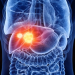 Identifican una nueva vía para potenciar la inmunoterapia contra el cáncer de hígado
