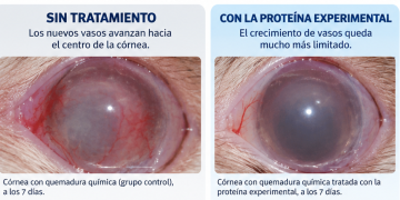 Una proteína experimental evitó que nuevos vasos invadieran las capas profundas de la córnea tras una quemadura química