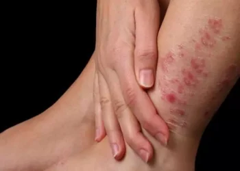 Día Mundial de la Psoriasis: ¿por qué se celebra el 29 de octubre?