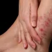 Día Mundial de la Psoriasis: ¿por qué se celebra el 29 de octubre?